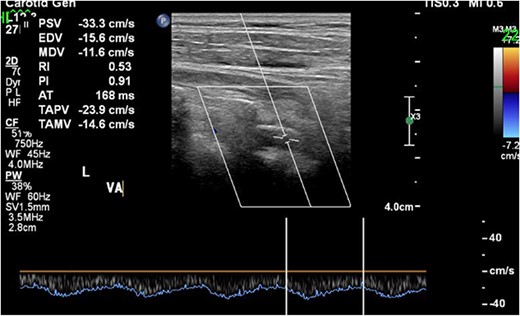 CDUS showed the antegrade flow of the left VA at the end of the operation. CDUS, carotid Doppler ultrasonic echography; VA, vertebral artery.