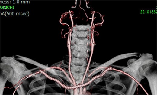 ECT after operation showed the patency of the bypass graft and adequate flow of the left VA. ECT, enhanced computed tomography; VA, vertebral artery.