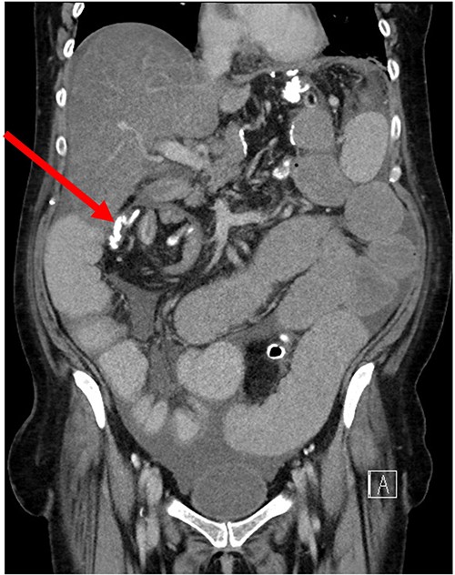 Coronal CT of SBO secondary to internal hernia.