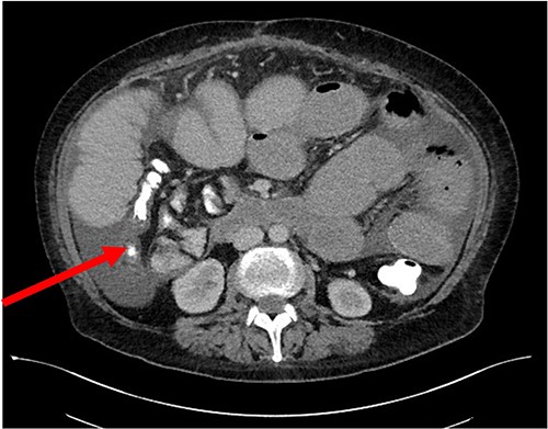 Axial CT of SBO secondary to internal hernia.