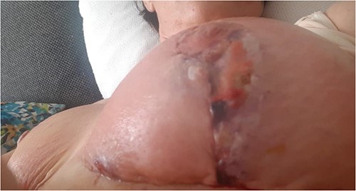 Figure representing superficial skin changes including erythema and skin necrosis of the Left breast on presentation