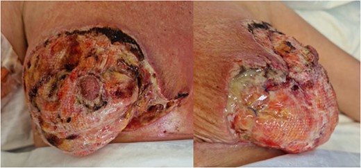 Right and left breasts before second debridement