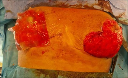 Figure representing bilateral breasts post debridement—this was taken after the third debridement attempt. Application of Integra can be noted on the right breast