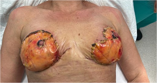 Figure representing clear dermal regeneration under the outer silicon sheath of the Bilayer Matrix at Day 14