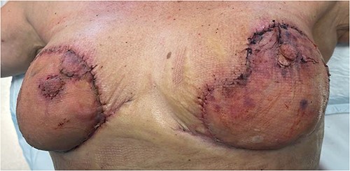 Figure representing 100% graft uptake