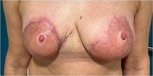 Figure representing the aesthetic outcome several weeks after multiple debridement Integra and split thickness skin graft application
