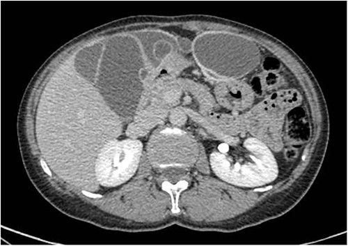 Axial CT-scan highlighting the abdominal pluriconcameral cystic formation.