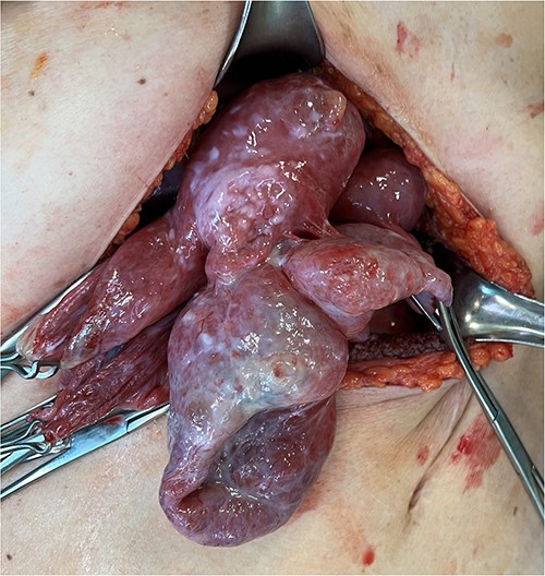 Intraoperative findings showing the multiloculated epigastric tumor.