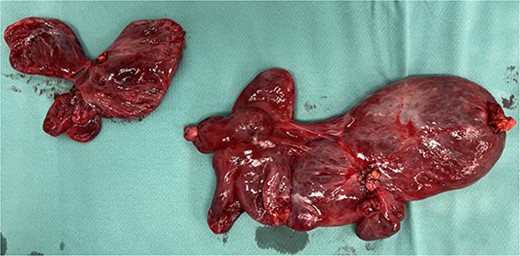 Surgical piece illustrating the two vascular pedicles of the neoformation.