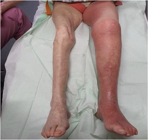 Clinical findings upon admission. Swelling of the left lower limb.