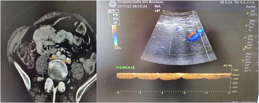 Radiological findings. Thrombosis of the left common/extern iliac vein as seen upon CT-scan and sonography.
