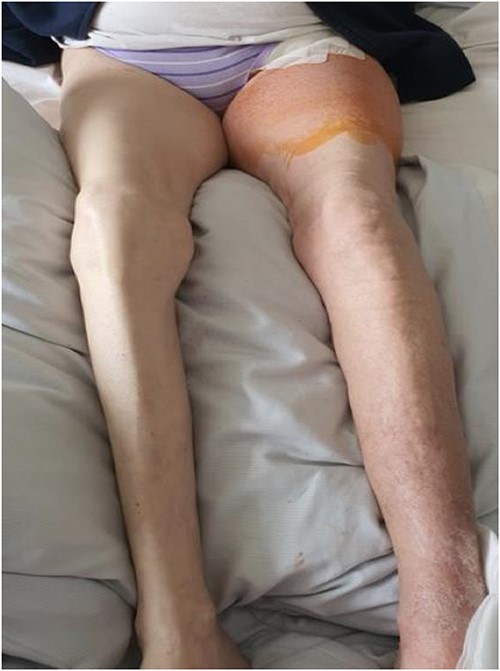 Clinical findings upon dismission. Notable improvement in swelling of the lower left limb.
