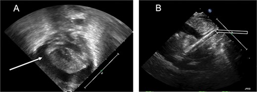 Echocardiogram. (A) Apical view, pericardial effusion (white solid arrow). (B) Subcostal view, ECMO catheter tip seen entering the right atrium (white hollow arrow).