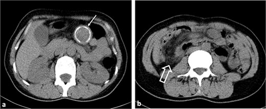 Axial non-contrast CT images. (a) A hypodense lesion (thin arrow) with peripheral calcification is observed in the left upper quadrant of the abdomen. (b) Ileocolic intussusception is observed in the right lower quadrant of the abdomen (thick arrow).