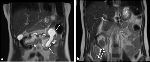 Coronal T2WI MR images. (a) Tubular lesion (thin arrow) consistent with hyperintense appendiceal mucocele is observed in the left upper quadrant of the abdomen. (b) Ileocolic intussusception is observed in the right lower quadrant of the abdomen (thick arrow).