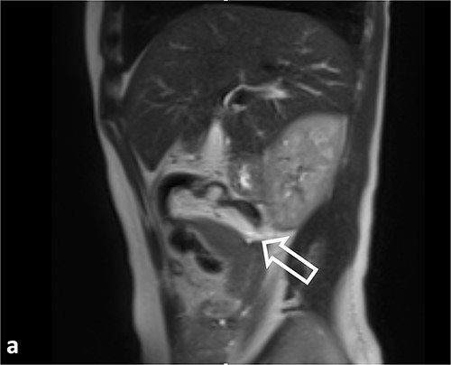 Sagittal T2WI MR images. Ileocolic intussusception (thick arrow).