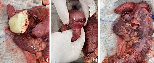 The neoplasm mass along with right colon, ileum and the appendix. (a) Mucinous neoplasm of the appendix. (b) Intussusception of the base of the appendix in the cecum. (c) Right hemicolectomy.