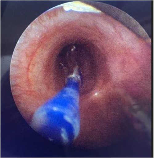 Direct visualization of a 5 mm balloon over a 3.5 mm bronchoscope dilating the left main bronchus.