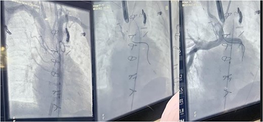 Fluoroscopic intraoperative images of left mainstem bronchus balloon dilation.