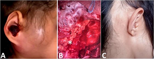 (A) Image showing a right retro-auricular and parotid swilling with a polyp of the external auditory meatus. (B) Reconstruction with abdominal fat (star). (C) Clinical picture after surgery and reconstruction.