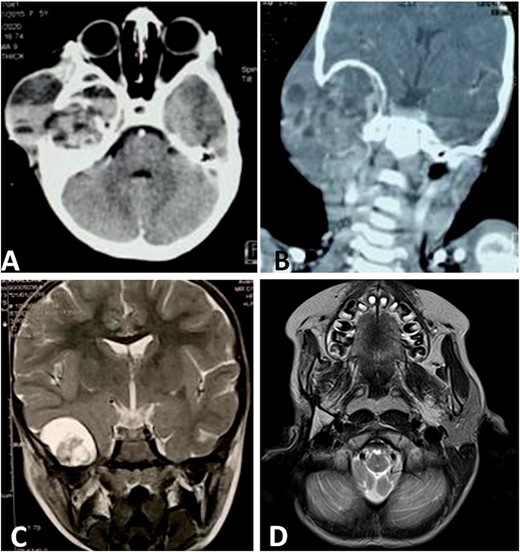CT scan shows a cystic process of the middle ear cavities with a significant osteolysis of the petrous bone, mastoid and temporal bone (A) with extension to parotid region (B) and homolateral meninge and brain (C). Follow-up MRI shows no sign of recurrences (D).