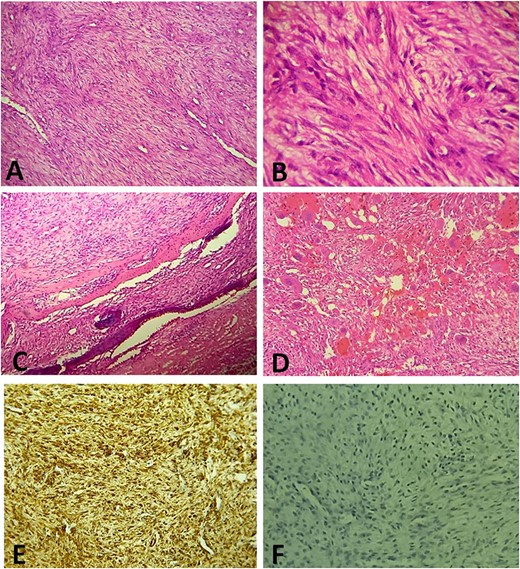 (A) Histologically, the tumor is composed of spindle cell proliferation with an alternation of hypocellular zones and cellular zones associated with haemangiopericytic architecture (Hematoxylin-Eosinx10). (B) Tumor cells have elongated nuclei with fine chromatin and a small nucleolus (Hematoxylin-Eosinx40). (C) Tumor infiltrating temporal bone (Hematoxylin-Eosinx20). (D) Note the polymorphic inflammatory reaction rich in giant cells (Hematoxylin-Eosinx20). At the immunohistochemistry, tumor cells are positive for SMA (E) and negative for Desmin, Myogenin, CD34 and ALK (F).