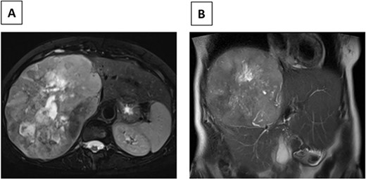 (A) Axial MRI image (T2) of R hepatic lobe mass. (B) Coronal MRI image (T2) of R hepatic lobe mass.