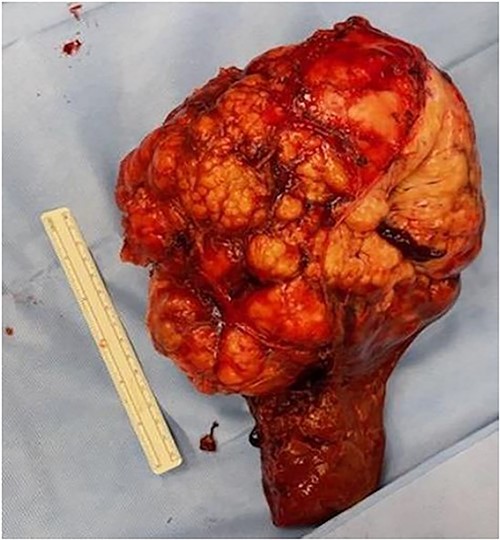 Right hepatic lobe surgical specimen.