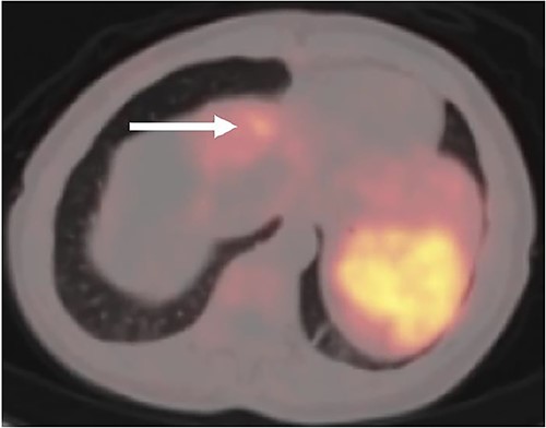 Postoperative (68Ga) DOTATATE PET/CT imaging demonstrating 1 cm intense lesion in segment 4A of the left hemiliver (white arrow).