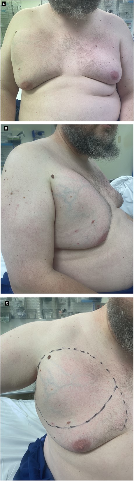(A-C) Clinical photos of male breast hibernoma.