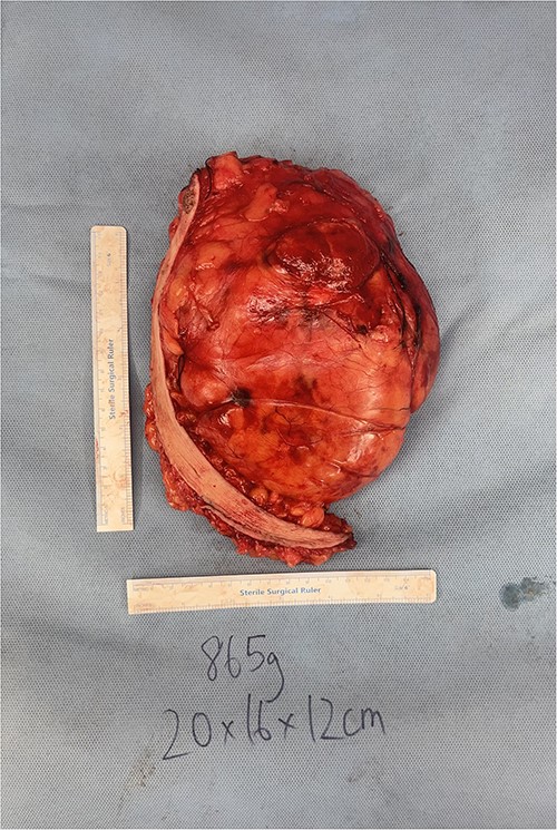 Intra-operative photos of breast hibernoma.