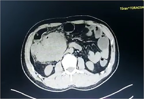 Abdominal computed tomography showing an intra-abdominal mass measuring 70 mm in diameter and compressing the small intestine.