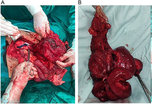 (A) Retroperitoneal mass invading the right colon, terminal ileum and part of the transverse colon. (B) Resected tumor sample for histopathology.