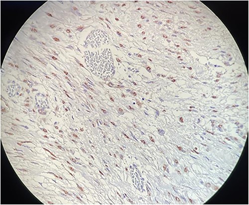 Microscopy: fusiform cell proliferation with positive β-catenin immunoreactivity.
