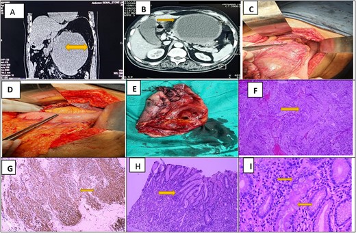 Radiological (CT Scan) and Histopathological features of GI stromal tumor. (A) and (B) Sagital and axial slices show a colossal hypo intense cyst measuring 17 × 16 × 15 cm closely abutting the anterior gastric wall forming a claw around it. The cyst has a maximum wall thickness of 1.4 cm with no internal solid or papillary areas. (C) Intra-operative images of massive cystic swelling adherent to the lesser curvature of stomach approaching lesser omentum and gastrocolic ligament. (D) After cyst resection, reverse sleeve gastrectomy is done in a double-layered fashion. (E) Postoperative image shows a cyst resection specimen with a smooth external surface and internal hemorrhagic surface. (F) Photomicrograph of H&E stain shows neoplastic spindle cells arranged whorls and palisading of nuclei noted. (G) Strong and diffuse cytoplasmic staining of CD 117 in tumor cells. (H) and (I) Photomicrograph of H&E stain shows low and high-power view of adjacent gastric mucosa with extensive chronic changes (Crock screwing, budding, branching and foveolar hyperplasia) and IM (highlighted by yellow arrows).
