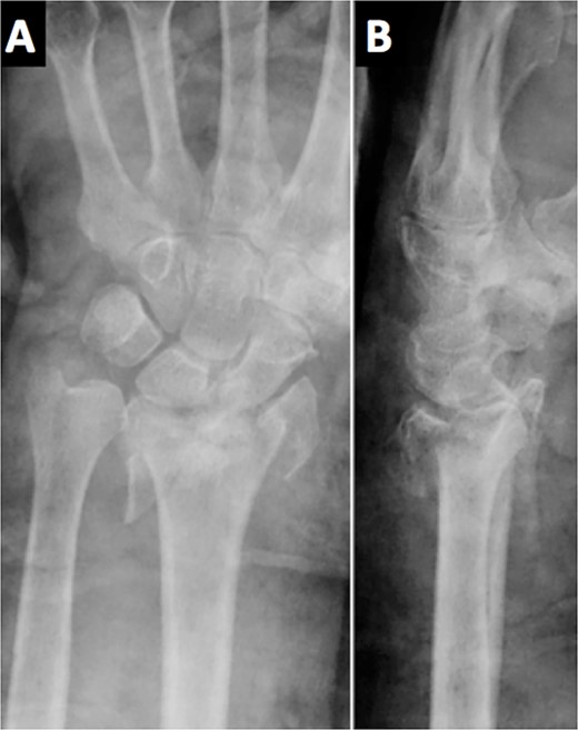 The radiological images in the emergency department showed a comminuted intra-articular displaced fracture of the distal radius.