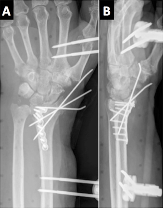 Immediate postoperative radiological assessment.