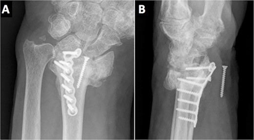 Radiological evidence of a migrated screw lodged in the anterior aspect of the wrist.