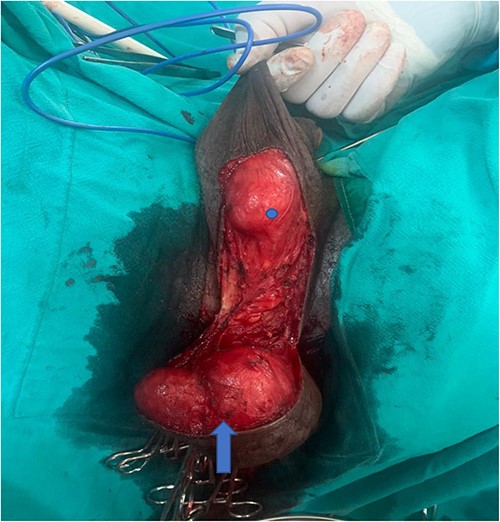 Lobulated mass (blue arrow) is adherent to the perineal skin and part of scrotal skin. One of the testes (blue dot) can be seen separate from the mass.