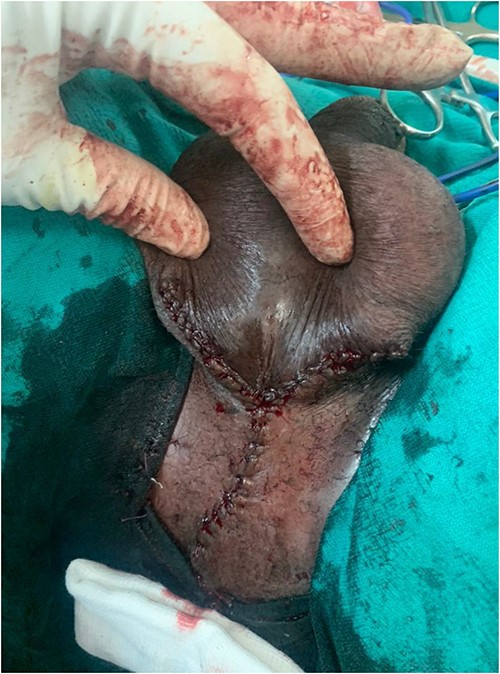 Image showing a primary wound closure in a Y-fashion.