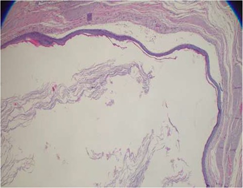 Photomicroscope highlighting a stratified squamous epithelial lining with a granular layer and abundant keratin flakes filling the cystic cavity (hematoxylin and eosin-stained sections, ×40 original magnification).