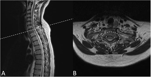 Preoperative MRI Scan December 2019. (A) Sagittal view of oligometastatic lesion at T2 vertebral body. (B) ESCC grade 2 determined as there is spinal cord compression, but with cerebrospinal fluid visible around the cord.