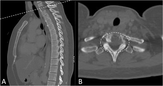 Preoperative CT Scan December 2019. Sagittal view of oligometastatic lesion at T2 vertebral body. (A) Sagittal view of oligometastatic lesion at T2 vertebral body. (B) Transverse view determined ESCC grade 2 as there is spinal cord compression, but with cerebrospinal fluid visible around the cord.
