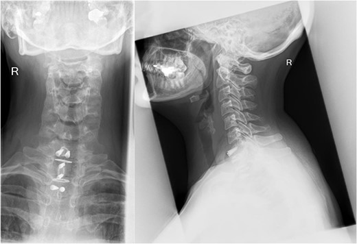 A 3-day postoperative X-ray of VBR and instrumentation in coronal (Right) and sagittal (Left) view.