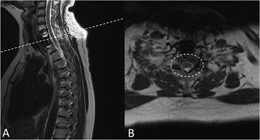 A 15-months postoperative follow up MRI Scan in May 2021. (A) Sagittal view of VBR cage indicating tumour free T2 body. (B) Transverse view of spinal compression reduction and resolved ESCC score.