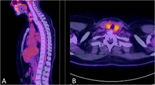 No signs of tumour recurrence at 30-months postoperative follow up PET-CT in July 2022.