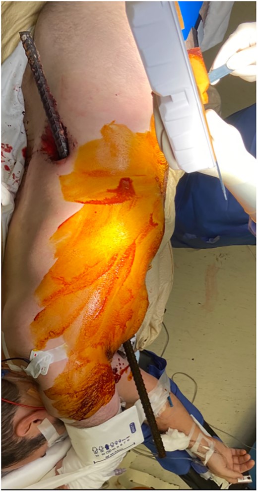 Rebar penetrating through the left flank through the left anterior chest.