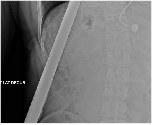 Abdominal X-ray demonstrating the rebar trajectory into the left anterior chest; the path is distorted secondary to patient positioning during imaging.