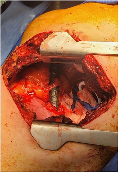 Thoracotomy incision revealing the rebar penetrating the diaphragm and coming in contact with the phrenic nerve.