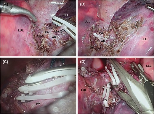 Stapleless thoracoscopic lobectomy procedure. (A) After the PA is exposed, A6, A9 and A10 are sealed and divided with LigaSure™. (B) The Hem-o-Lok® clip is placed on A8 proximally, and the vessel is divided distally with LigaSure™. (C) The left inferior pulmonary vein is double ligated with L-size Hem-o-Lok® clips, then sealed and divided distantly with LigaSure™. (D) Double ligation of the LLL bronchus with L-size Hem-o-Lok® clips and division with scissors. B, left lower lobe bronchus; LUL, left upper lobe; PA, interlobar pulmonary artery; PV, inferior pulmonary vein.